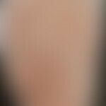 Pityriasis rosea: Historische Moulage. Abbildung entnommen aus: K. Zieler, Atlas der Haut- und Ge...