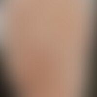 Pityriasis rosea: Historisc... Pityriasis rosea: Historische Moulage. Abbildung entnommen aus: K. Zieler, Atlas der Haut- und Ge...