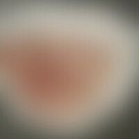 Herpes labialis: Historisch... Herpes labialis: Historische Moulage. Abbildung entnommen aus: K. Zieler, Atlas der Haut- und Ges...
