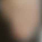 Paronychie chronische (syphilitische Paronychie): Historische Moulage. Abbildung entnommen aus: K...