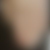 Paronychie chronische (syph... Paronychie chronische (syphilitische Paronychie): Historische Moulage. Abbildung entnommen aus: K...