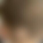 Differenzialdiagnose Alopecia areata. Diagnose: Mikrosporie. Historische Moulage. Abbildung entno...
