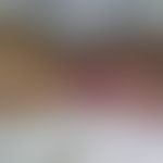 Chronisch rezidivierende anuläre neutrophile Dermatose: scharf begrenzte feste, schmerzhafte Plaq...