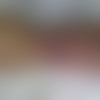 Chronisch rezidivierende an... Chronisch rezidivierende anuläre neutrophile Dermatose: scharf begrenzte feste, schmerzhafte Plaq...