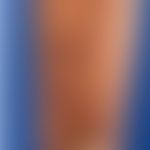 Leishmaniasis kutane: nach einem Urlaub aufgetretene,wenig symptomatische, rundliche, rot-braune ...