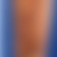 Leishmaniasis kutane: nach ... Leishmaniasis kutane: nach einem Urlaub aufgetretene,wenig symptomatische, rundliche, rot-braune ...
