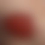 Leishmaniasis kutane solitäre (klassische Orientbeule): flach ulzerierte, wenig schmerzhafte Plaq...