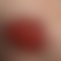 Leishmaniasis kutane solitä... Leishmaniasis kutane solitäre (klassische Orientbeule): flach ulzerierte, wenig schmerzhafte Plaq...