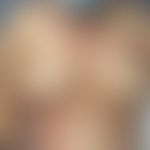 Dyskeratosis follicularis: Teils locker disseminierte, teils gruppiert stehende, teils aggregiert...