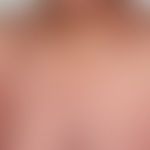 DRESS: nach Einnahme von Carbemazepin und nach COVID-Vakzinierung (s. Fallbericht 3) Auftreten di...
