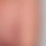 DRESS: nach Einnahme von Carbemazepin und nach COVID-Vakzinierung (s. Fallbericht 3) Auftreten di...
