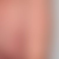DRESS: nach Einnahme von Ca... DRESS: nach Einnahme von Carbemazepin und nach COVID-Vakzinierung (s. Fallbericht 3) Auftreten di...
