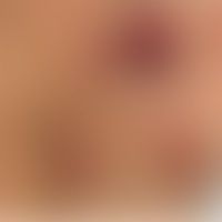 Lymphoproliferative Erkrank... Lymphoproliferative Erkrankung Methotrexat-bedingte kutane: unterschiedlich große, papulöse bzw. ...