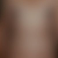 Seabather`s eruption: dicht... Seabather`s eruption: dichtstehende juckende Papeln nach Meeresbad. Abb. entnommen aus: Dinulos ...