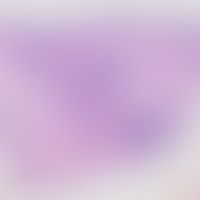 Histiozytose intralymphatis... Histiozytose intralymphatische: Histologischer Befund mit knotigen lymphozytären Infiltraten im ...