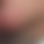 Histiozytose intralymphatische: Klinischer  Befund mit mäßig angeschwollener und geröteter Kinnre...