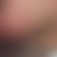 Histiozytose intralymphatis... Histiozytose intralymphatische: Klinischer Befund mit mäßig angeschwollener und geröteter Kinnre...