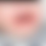 Acrodermatitis enteropathica: chronische, ekzematöse Läsionen. S. Köbner-Phänomene. Abb. entnomme...