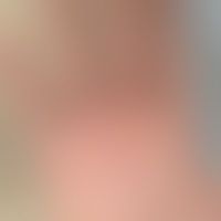 Pityriasis lichenoides (et ... Pityriasis lichenoides (et varioliformis) acuta (Typ febrile papulo-ulzeröse Mucha-Habermann-Erkr...