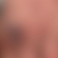 Pityriasis lichenoides (et ... Pityriasis lichenoides (et varioliformis) acuta (Typ febrile papulo-ulzeröse Mucha-Habermann-Erkr...