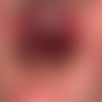 Pityriasis lichenoides (et ... Pityriasis lichenoides (et varioliformis) acuta (Typ febrile papulo-ulzeröse Mucha-Habermann-Erkr...
