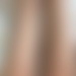 Kokain-induzierte Vaskulitis: Kleingefäßvaskulitis bei chonischem Kokainabusus. Abb entnommen aus...