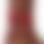 Erythema induratum (Bazin): Großflächige, stellenweise konfluierte Ulzera und idurierte Plaques b...