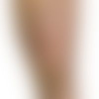 Erythema induratum (Bazin):... Erythema induratum (Bazin): Frische und bereits abgeheilte ulzerierte Knoten und PLaques bei nach...