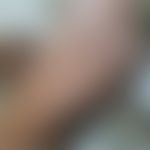 Lichenoides Tuberkulid: disseminierte follikuläre Papeln und konfluierte schuppige Plaques. Abb. ...
