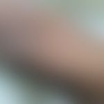 Lichenoides Tuberkulid: disseminierte follikuläre Papeln und schuppende Plaques. Abb. entnommen a...
