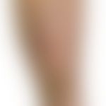 Erythema induratum: Indurierte Plaques, Ulcera und abgeheilte eingesunkene Narben. Abb. entnommen...