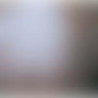 Papulonekrotisches Tuberkul... Papulonekrotisches Tuberkulid: Buntes Bild mit unterschiedlichen Stadien (Narben, nicht-follikulä...
