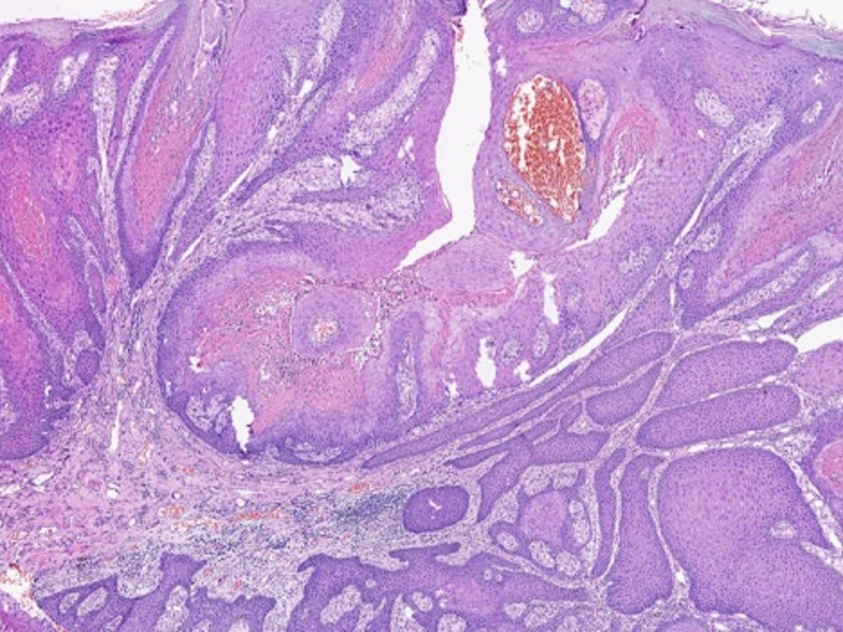 Another dermatofibroma variant: lipidized aka “ankle type” (bc it occurs on  lower leg). Foamy histiocytes mimic xanthoma. Rings/arcs of hyalinized  collagen \u0026 peripheral areas of conventional DF \u003d clues to dx. My, image size:1200x900