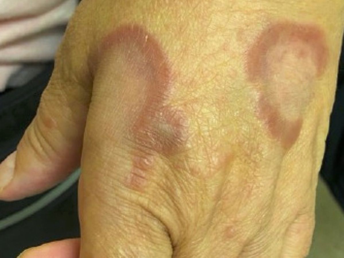 Granuloma anulare (overview) - Altmeyers Encyclopedia - Department  Dermatology