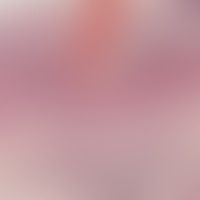 Stratum corneum/Porokeratos... Stratum corneum/Porokeratose: fokaler Parakeratosekegel über einem Epidermissegment mit Dyskerato...