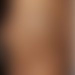 Lupus erythematodes profundus (Lupus-Pannikulitis): flächenhaft induriertes, hyperpigmentiertes A...