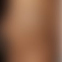 Lupus erythematodes profund... Lupus erythematodes profundus (Lupus-Pannikulitis): flächenhaft induriertes, hyperpigmentiertes A...