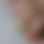 Onychogrypose: schwere Ausp... Onychogrypose: schwere Ausprägung einer isolierten Form der Onychogrypose mit grotesk eingerollte...
