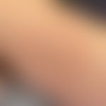 Erythema migrans: seit weni... Erythema migrans: seit wenigen Wochen bestehendes zentrifugal migrierendes, symptomloses Erythem....