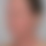 Atopische Head-and-Neck-Der... Atopische Head-and-Neck-Dermatitis: schwere disseminierte Ekzemreaktion an Gesichts- und Halspart...