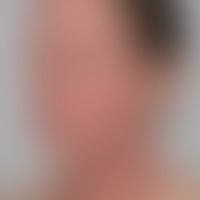 Atopische Head-and-Neck-Der... Atopische Head-and-Neck-Dermatitis: schwere disseminierte Ekzemreaktion an Gesichts- und Halspart...