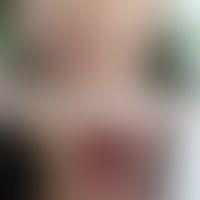 Hyper-IgE-Syndrom autosomal... Hyper-IgE-Syndrom autosomal rezessiv, DOCK8–Mangel-Syndrom: schwere atopische Dermatitis mit tro...
