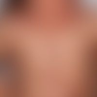 Hyper-IgE-Syndrom autosomal... Hyper-IgE-Syndrom autosomal rezessiv, DOCK8–Mangel-Syndrom: schwere atopische Dermatitis mit mas...