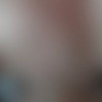Immunrekonstitutions-Follik... Immunrekonstitutions-Follikulitis: Dissemnierte follkuläre entzündliche Papeln, wenige Pusteln. A...