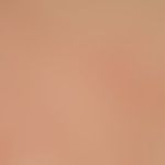Differenzialdiagnose: Immunrekonstitutions-Follikulitis

Diagnose: Malassezia-Follikulitis. Dis...