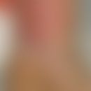 Streptococcus pyogenes: Sch... Streptococcus pyogenes: Schwerer ulzerierter Weichteilabszess. Abb. entnommen aus: Jantsch J et a...