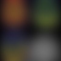 75J. Patientin mit AD; abnormales Amyloid PET (oben links);  tau PET with flortaucipir (oben rech...