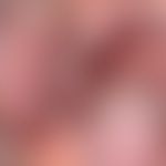 Grinspan-Syndrom: Zeichen des bds. oralen Lichen planus mit hyperpigmentierten Plaques. Abb. entn...