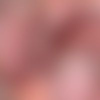 Grinspan-Syndrom: Zeichen des bds. oralen Lichen planus mit hyperpigmentierten Plaques. Abb. entn...