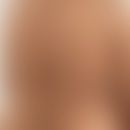 Grinspan-Syndrom: Klinische Zeichen des Pemphigus vulgaris. Abb. entnommen aus: Saddik A et al. 2...